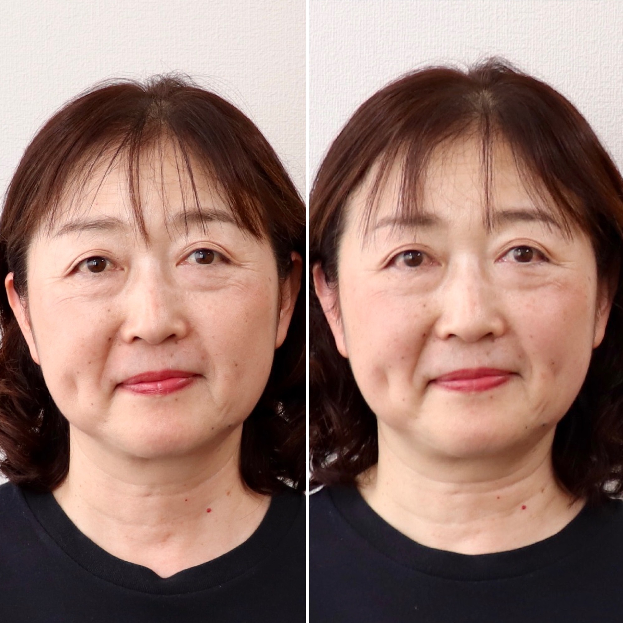 症例|美容鍼 症例|美容鍼