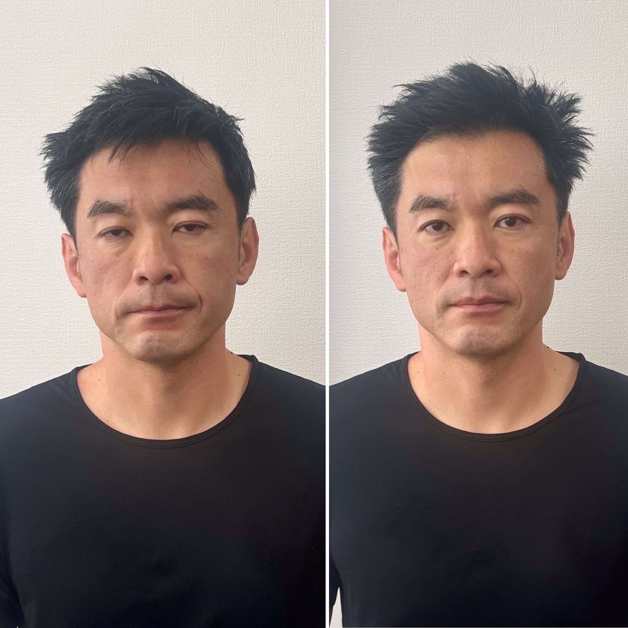 症例|美容鍼 症例|美容鍼